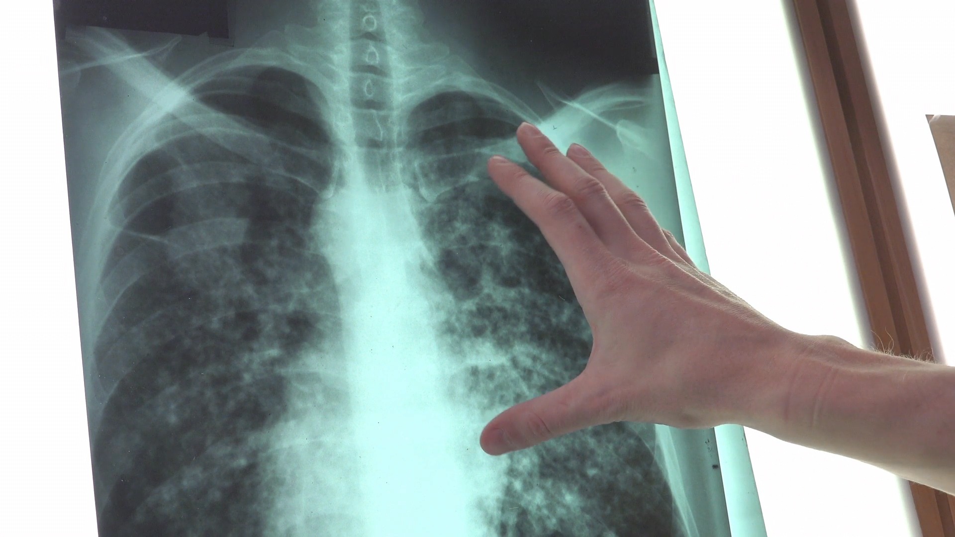 Omeopatia come terapia complementare per carcinoma polmonare: un nuovo studio