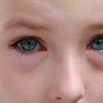 Le persone allergiche sono sempre di più