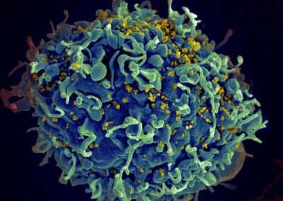 Pazienti HIV “curati” dalla loro biologia individuale possono nascondere i segreti per porre fine al flagello globale