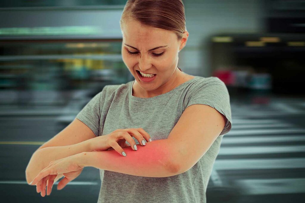 Reazioni-allergiche-cutanee