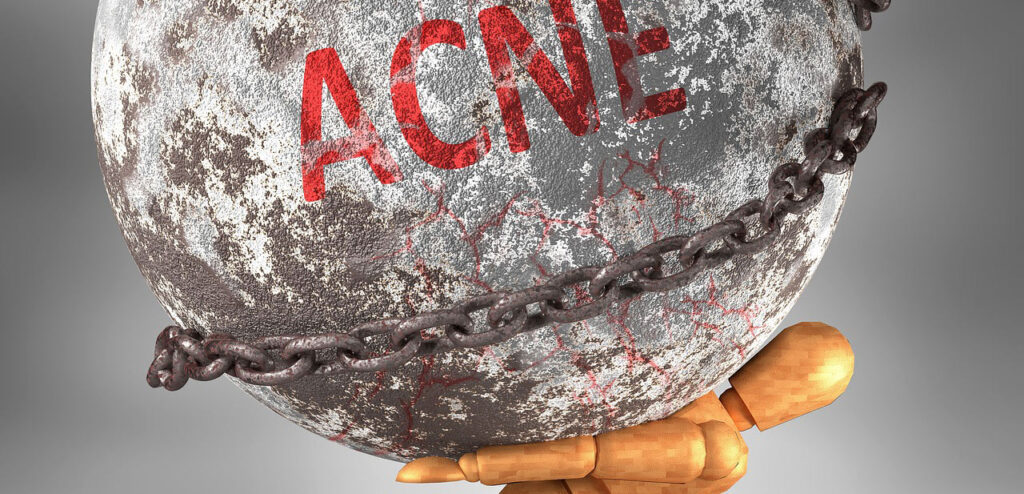 acne-giovanile