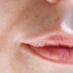 Omeopatia: soluzione efficace per l'acne negli adolescenti